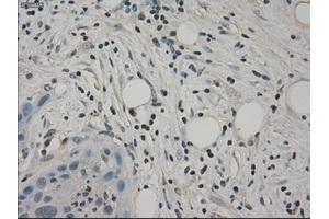 Immunohistochemical staining of paraffin-embedded Carcinoma of pancreas tissue using anti-SLC2A5mouse monoclonal antibody. (SLC2A5 Antikörper)