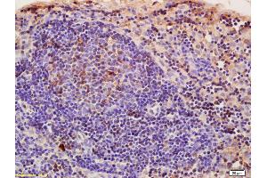Formalin-fixed and paraffin embedded rat pancreatic cancer labeled with Anti-CRIM1 Polyclonal Antibody, Unconjugated (ABIN676853) at 1:200, followed by conjugation to the secondary antibody and DAB staining (CRIM1 Antikörper  (AA 901-1028))