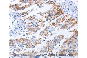 Immunohistochemistry of Human lung cancer using KIF3A Polyclonal Antibody at dilution of 1:40 (KIF3A Antikörper)