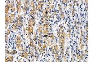 Occludin Mouse Monoclonal Antibody at 1/100 staining human gastric cancer and adjacent non-tumor tissue by IHC-P. (Occludin Antikörper  (Internal Region))