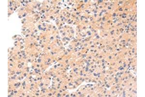 The image on the left is immunohistochemistry of paraffin-embedded Human liver cancer tissue using ABIN7191067(IKZF4 Antibody) at dilution 1/20, on the right is treated with synthetic peptide. (IKZF4 Antikörper)