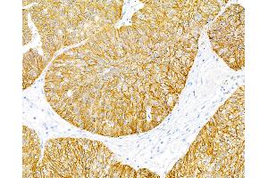 Immunohistochemistry (IHC) image for anti-Epithelial Cell Adhesion Molecule (EPCAM) (AA 24-265) antibody (ABIN7453970) (Rekombinanter EpCAM Antikörper  (AA 24-265))