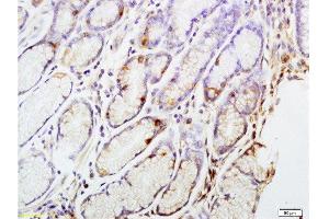 Formalin-fixed and paraffin embedded human gastric carcinoma tissue labeled with Anti-CENPA Polyclonal Antibody, Unconjugated at 1:200 followed by conjugation to the secondary antibody and DAB staining (CENPA Antikörper  (AA 65-140))