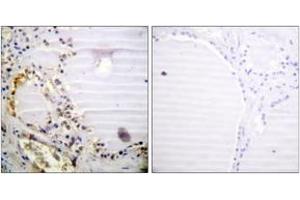 Immunohistochemistry analysis of paraffin-embedded human thyroid gland tissue, using RBBP8 (Ab-664) Antibody. (Retinoblastoma Binding Protein 8 Antikörper  (AA 630-679))