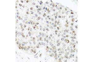 Immunohistochemistry of paraffin-embedded human lung cancer using CETN3 antibody (ABIN5974786) at dilution of 1/100 (40x lens). (CETN3 Antikörper)
