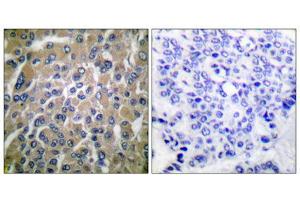 Immunohistochemical analysis of paraffin-embedded human breast carcinoma tissue using hCG beta antibody (ABIN5976419).