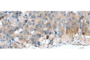 Immunohistochemistry of paraffin-embedded Human liver cancer tissue using HSD11B1 Polyclonal Antibody at dilution of 1:70(x200) (HSD11B1 Antikörper)