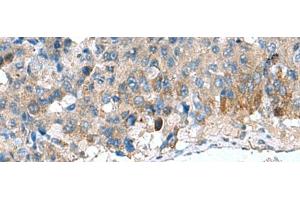 Immunohistochemistry of paraffin-embedded Human liver cancer tissue using HSD11B1 Polyclonal Antibody at dilution of 1:70(x200) (HSD11B1 Antikörper)