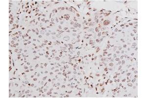 ABIN6267365 at 1/200 staining Human lung cancer tissue sections by IHC-P.