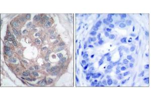 Immunohistochemical analysis of paraffin-embedded human breast carcinoma tissue, using Dab1 (Ab-232) antibody (E021251). (DAB1 Antikörper)