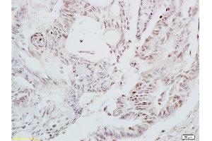 Formalin-fixed and paraffin embedded human colon carcinoma tissue labeled with Anti-LEF-1 Polyclonal Antibody, Unconjugated at 1:200 followed by conjugation to the secondary antibody and DAB staining