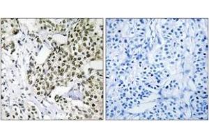 Immunohistochemistry analysis of paraffin-embedded human breast carcinoma tissue, using CAGE1 Antibody. (CAGE1 Antikörper  (AA 711-760))