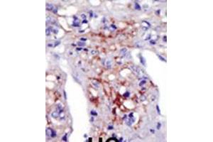 Formalin-fixed and paraffin-embedded human cancer tissue reacted with the primary antibody, which was peroxidase-conjugated to the secondary antibody, followed by AEC staining. (PIP5K1C Antikörper  (N-Term))