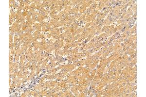 ABIN7094620 and ABIN7098670 at 1/100 staining Human liver cancer and adjacent normal tissues by IHC-P. (CRAT Antikörper  (Internal Region))