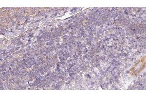 ABIN6273057 at 1/100 staining Human lymph cancer tissue by IHC-P. (MTHFD2 Antikörper  (N-Term))