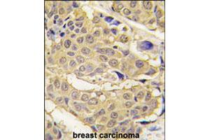 Formalin-fixed and paraffin-embedded human breast carcinoma tissue reacted with EPRS polyclonal antibody  , which was peroxidase-conjugated to the secondary antibody, followed by DAB staining. (EPRS Antikörper  (N-Term))