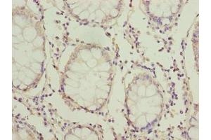 Immunohistochemistry of paraffin-embedded human colon cancer using ABIN7165635 at dilution of 1:100 (HOOK1 Antikörper  (AA 301-600))