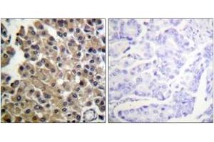 Immunohistochemistry analysis of paraffin-embedded human breast carcinoma tissue, using PDGFRB (Ab-1009) Antibody.
