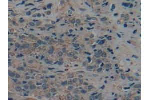 Detection of CK9 in Human Prostate cancer Tissue using Polyclonal Antibody to Cytokeratin 9 (CK9) (KRT9 Antikörper  (AA 315-456))