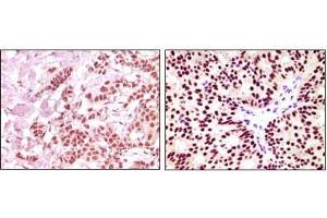 Immunohistochemical analysis of paraffin-embedded human breast carcinoma, using ER-alpha mouse mAb showing nuclear expression with DAB staining. (Estrogen Receptor alpha Antikörper  (AA 410-592))