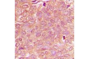 Immunohistochemical analysis of NBEAL1 staining in human breast cancer formalin fixed paraffin embedded tissue section. (NBEAL1 Antikörper)