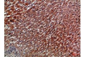 Immunohistochemical analysis of paraffin-embedded Human-liver-cancer, antibody was diluted at 1:100 (CXCR1 Antikörper  (AA 1-50))