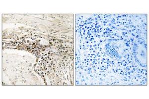 Immunohistochemistry analysis of paraffin-embedded human lung carcinoma tissue using SSH3 antibody. (SSH3 Antikörper  (Internal Region))