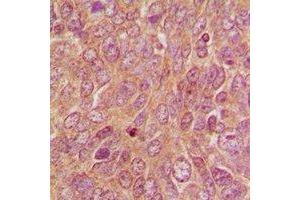 Immunohistochemical analysis of DUSP9 staining in human breast cancer formalin fixed paraffin embedded tissue section. (DUSP9 Antikörper)