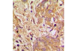 Immunohistochemical analysis of VEGFB staining in human breast cancer formalin fixed paraffin embedded tissue section. (VEGFB Antikörper  (Center))