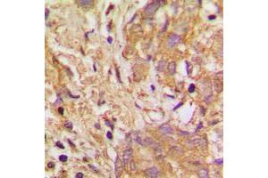 Immunohistochemical analysis of VEGFB staining in human breast cancer formalin fixed paraffin embedded tissue section.