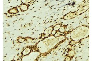 ABIN6274369 at 1/100 staining Human breast cancer tissue by IHC-P. (Translin Antikörper  (Internal Region))
