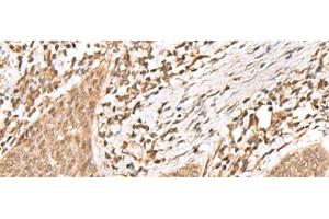 Immunohistochemistry of paraffin-embedded Human esophagus cancer tissue using KDM2A Polyclonal Antibody at dilution of 1:55(x200) (KDM2A Antikörper)