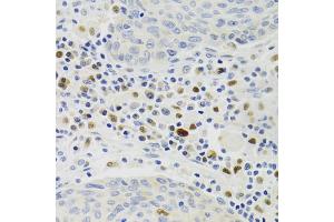 Immunohistochemistry of paraffin-embedded human lung cancer using GEMIN2 Antibody (ABIN1872798) at dilution of 1:100 (40x lens). (SIP1 Antikörper)