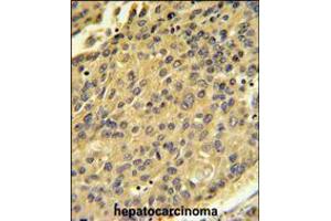 CTSH Antibody IHC analysis in formalin fixed and paraffin embedded human hepatocarcinoma followed by peroxidase conjugation of the secondary antibody and DAB staining. (Cathepsin H Antikörper  (N-Term))