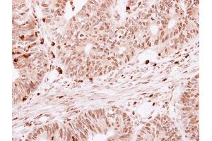 IHC-P Image SKAP55 antibody detects SKAP1 protein at cytoplasm on human colon carcinoma by immunohistochemical analysis.