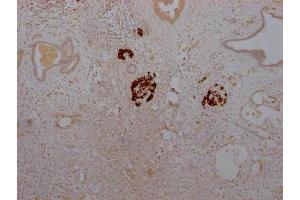 IHC image of ABIN7127574 diluted at 1:100 and staining in paraffin-embedded human pancreatic cancer performed on a Leica BondTM system. (Rekombinanter Insulin Antikörper)