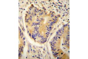 ADH4 antibody immunohistochemistry analysis in formalin fixed and paraffin embedded human colon carcinoma followed by peroxidase conjugation of the secondary antibody and DAB staining. (ADH4 Antikörper  (C-Term))