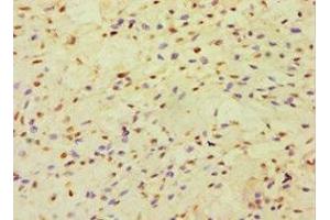 Immunohistochemistry of paraffin-embedded human breast cancer using ABIN7150999 at dilution of 1:100