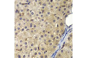 Immunohistochemistry of paraffin-embedded human liver cancer using AP2A2 antibody (ABIN6292468) at dilution of 1:200 (40x lens). (AP2A2 Antikörper)