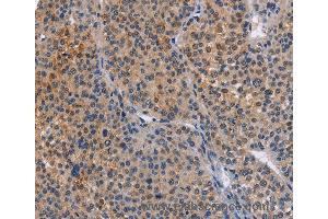 Immunohistochemistry of Human cervical cancer using MAP3K13 Polyclonal Antibody at dilution of 1:40 (MAP3K13 Antikörper)