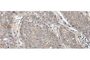 Immunohistochemistry of paraffin-embedded Human liver cancer tissue using UNC45B Polyclonal Antibody at dilution of 1:65(x200) (UNC45B Antikörper)