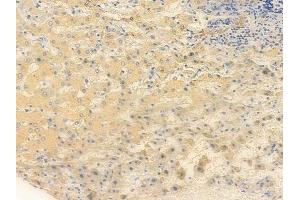 ABIN6256502 and ABIN6267435 at 1/100 staining human hepatocellular carcinoma by IHC-P. (SYT1/2 Antikörper  (pThr202))