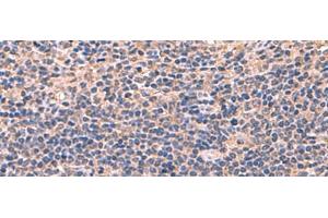 Immunohistochemistry of paraffin-embedded Human cervical cancer tissue using AHCYL1 Polyclonal Antibody at dilution of 1:70(x200) (AHCYL1 Antikörper)