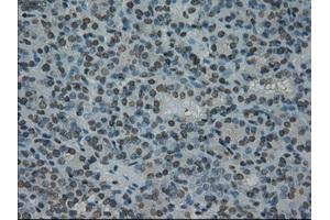 Immunohistochemical staining of paraffin-embedded Carcinoma of thyroid tissue using anti-PRKYmouse monoclonal antibody. (PRKY Antikörper)
