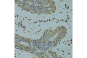 Immunohistochemistry of paraffin-embedded human breast cancer using DGKQ antibody (ABIN5972015) at dilution of 1/100 (40x lens). (DGKQ Antikörper)