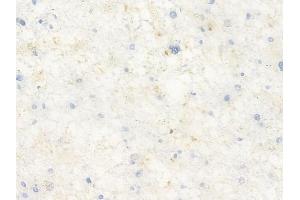 ABIN7093246 and ABIN7097263 at 1/100 staining human astrocytoma by IHC-P.