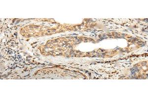 Immunohistochemistry of paraffin-embedded Human cervical cancer tissue using ZNF8 Polyclonal Antibody at dilution of 1:40(x200) (ZNF8 Antikörper)