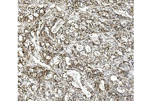 IHC analysis of Glutaminase/GLS using anti-Glutaminase/GLS antibody (ABIN7601603).