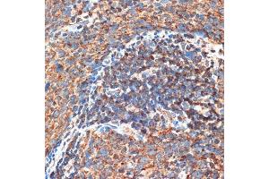 Immunohistochemistry of paraffin-embedded human esophageal cancer using FIP200 Rabbit pAb (ABIN7269881) at dilution of 1:100 (40x lens). (FIP200 Antikörper  (C-Term))