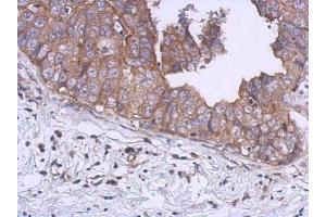 IHC-P Image Immunohistochemical analysis of paraffin-embedded human breast cancer, using UKHC, antibody at 1:500 dilution. (KIF5B Antikörper  (C-Term))